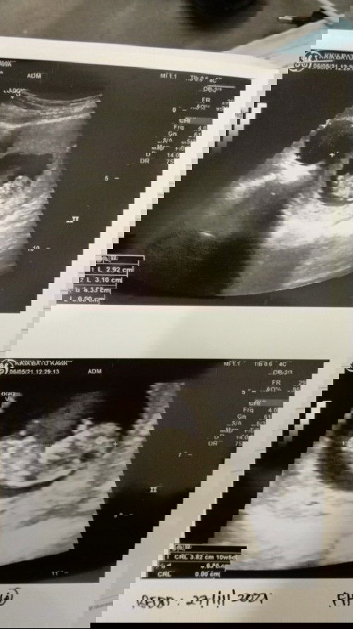 Kalau minggu 25 6 hari ?  Brpa bulan yer ? Maaf pelupa sedikit . Tapi perut still kecik 🥺hmmm .