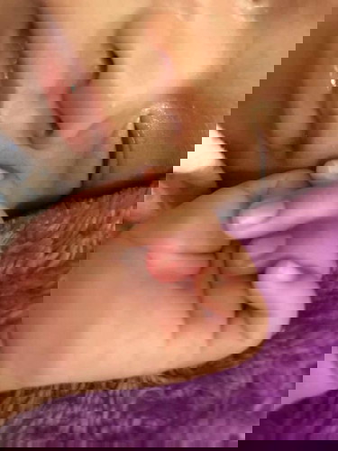 นิ้วบวมแดง.