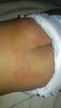 Diaper rash