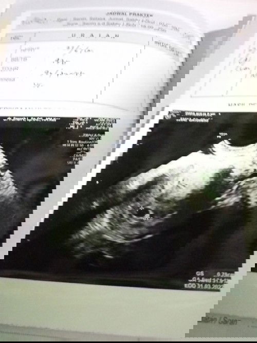 Janin tidak berkembang