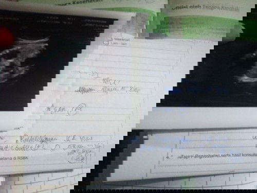 Air ketuban terlalu banyak