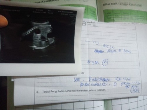 Air ketuban terlalu banyak