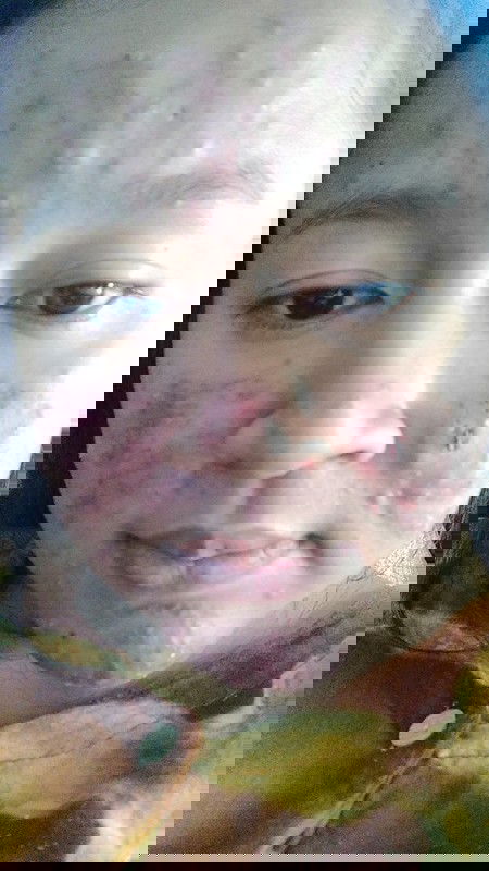 Jerawat parah saat ha