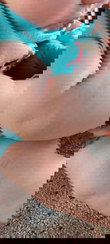 Có mẹ nào có thể cho e biết bé nhà e bị đây là bị chàm sữa đúng k ạ