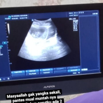 Bayi kembar