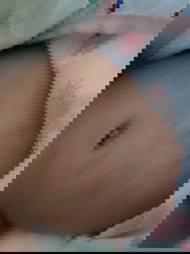 ผดผื่นแดงคัน