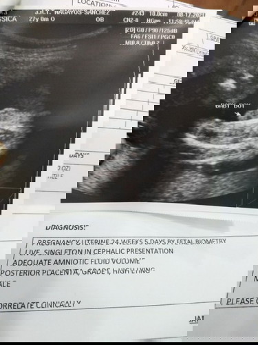 Nag pa ultrasound ako ng 6months, BOY ang Gender. Hindi kaya Nagkakamali ang Ultrasound?