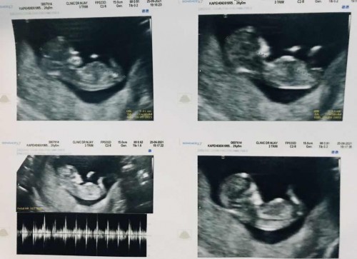 แม่ๆท่านไหนฉีดวัคซีนแล้วบ้างคะ