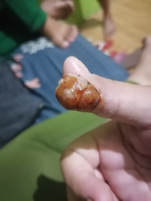 Pa tulong naman, baka may nakakaalam po sa inyo kung ano tong tumubo sa daliri ko. Buntis po ako.