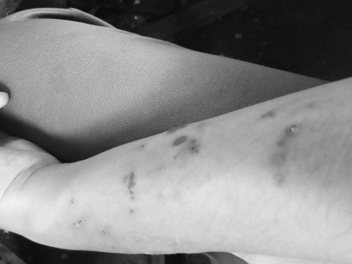 Gatal-gatal saat hamil