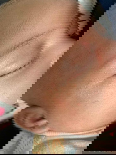 Baby rash?