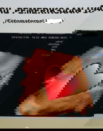 Masuk 37 Minggu posisi kepala udh masuk panggul