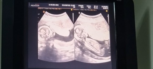 15w6d ผมเป็นผู้ชาย