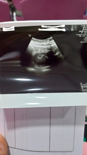 Bun share pengalaman nya dong, ada gak pas USG 5w6d dokter bilang ada 2 kantung kehamilan.??