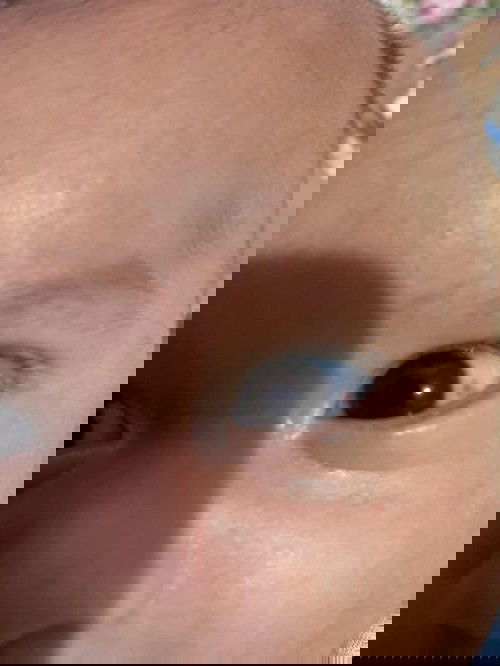 Bercak darah pada mata