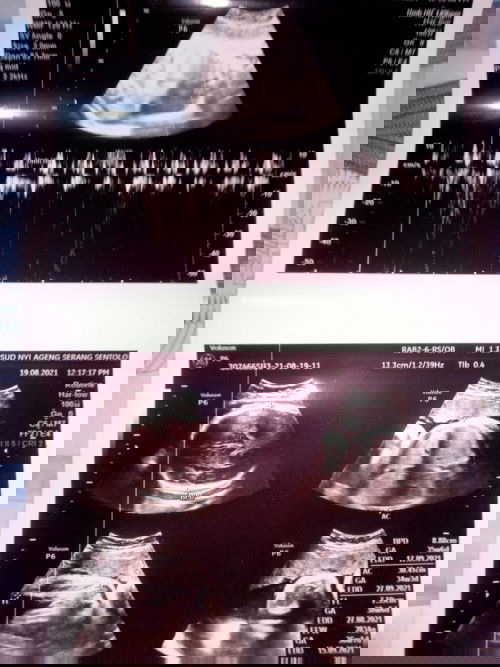 Arti USG Dimana letak ket Jenis kelamib