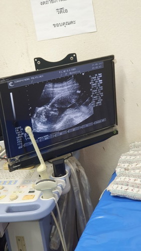 18 สัปดาห์