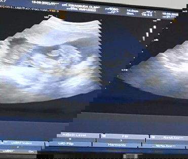 20สัปดาห์ เพศหญิง99%