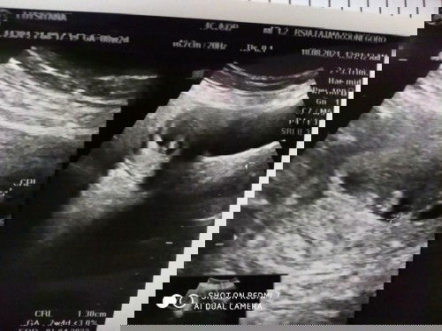 Bun,ada yang lagi samaan hamil 8week gak ya,apa badan sering meriang,kembung,mual parah gak bun?