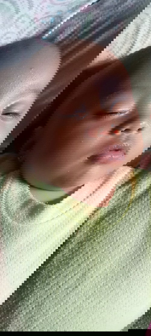 Bruntusan di muka bayi