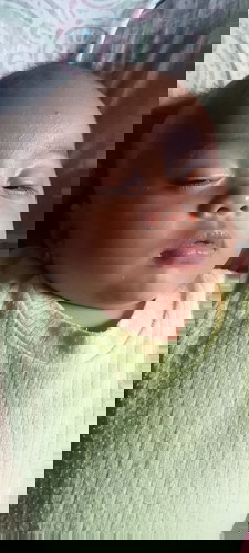 Bruntusan di muka bayi