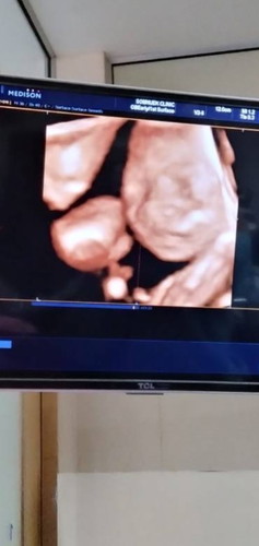 26สัปดาห์แร้วจร้าลูกสาวคนแรก