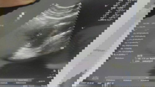 Kontrol usg setiap bulan