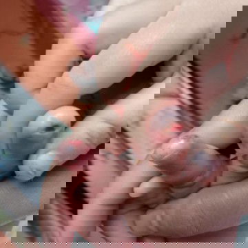 Jari tiba2 bengkak bernanah