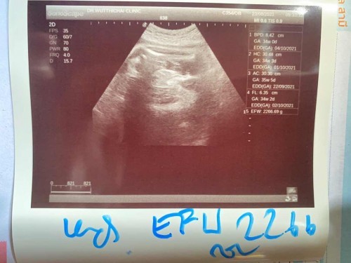 แม่ๆมีวิธีเพิ่มน้ำหนักลูกให้ขึ้นเร็วๆไหมคะ