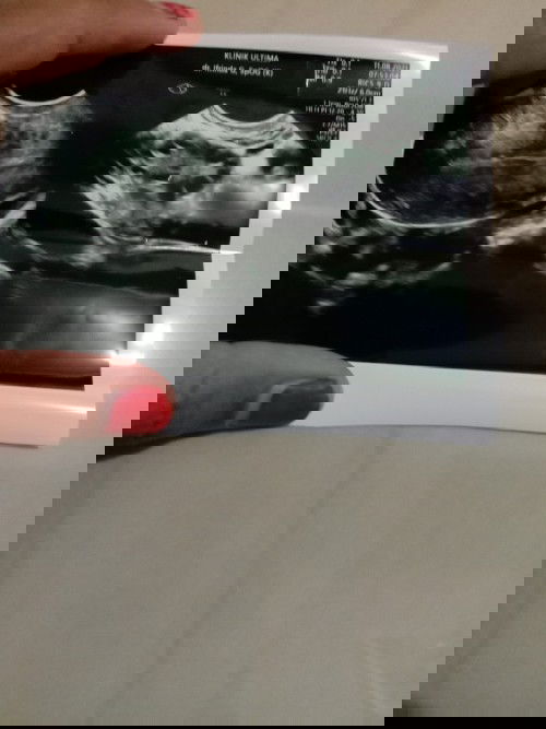 Penderita pco.gimana ya dok cara Promil sehatnya gak usah ke dokter??apa saja yg d konsumsi pco