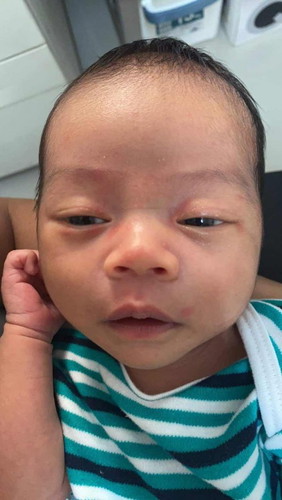 ลูกเป็นผื่นเม็ดเล็กๆ หัวขาว