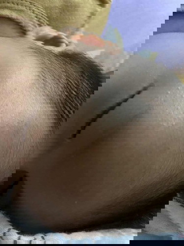 Bintik pda muka baby