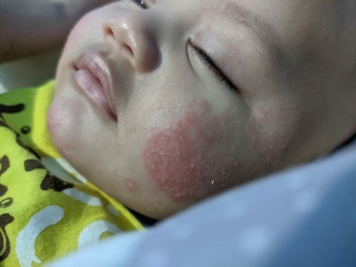 Rekomendasi dokter kulit untuk anak
