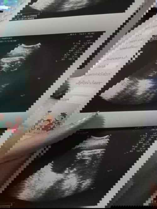 แม่คนไหนซาวด์แล้วลูกอยู่ในท่านี้บ้าง หมอบอกโอกาสคลอดเองน้อยมาก กลัวได้ผ่าอยากคลอดเองมากกว่า😄😄