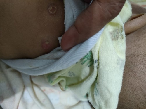 Punggung anak bruntusan dan ada airnya