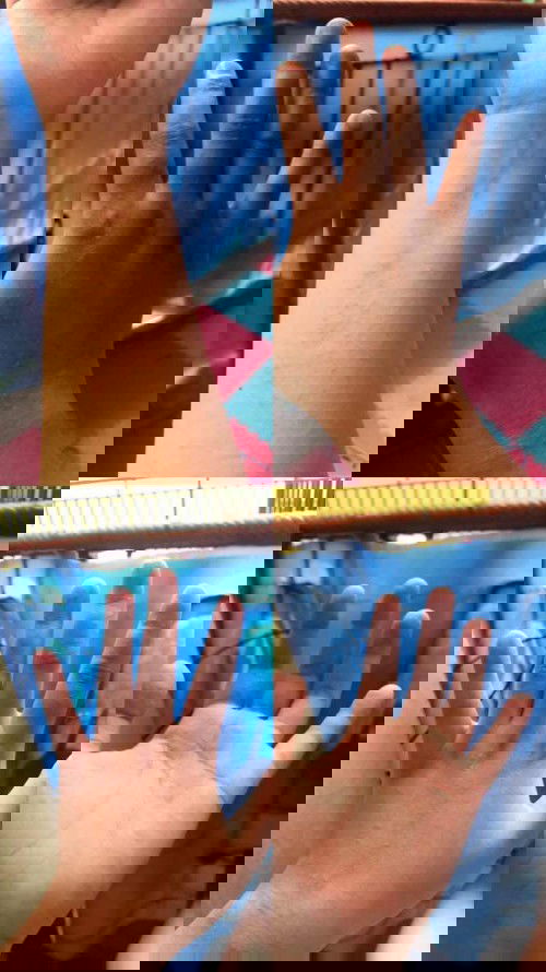 Gatal gatal di hamil 30minggu