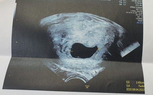 แบบนี้ต้องขูดมดลูกตามหมอแนะนำไหมคะ