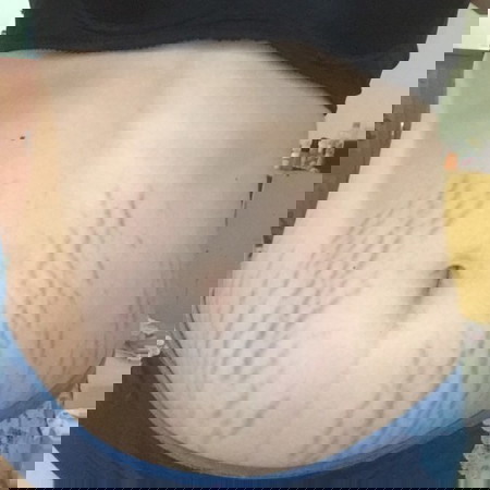 มีวิธีทำให้ท้องแตกลายจางลงบ้างมั้ยคะ