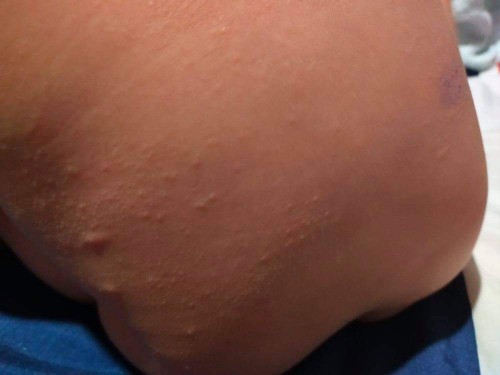 น้องเป็นผื่นเกิดจากอะไรคะ