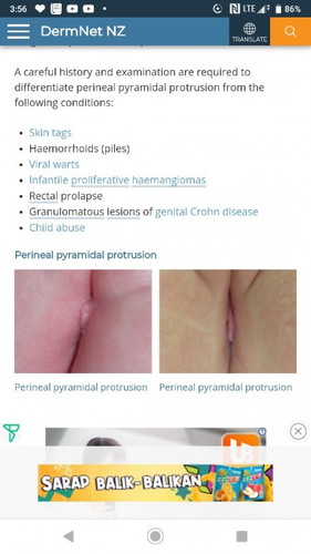 Perineal pyramidal protrusion in toddler