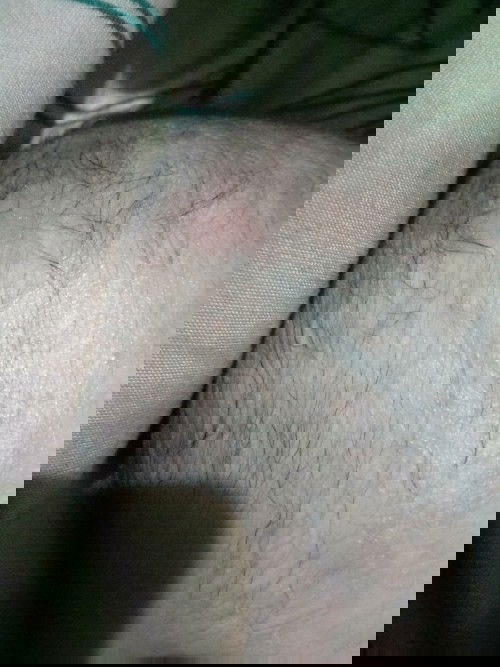 Kepala bayi berair disertai gatal