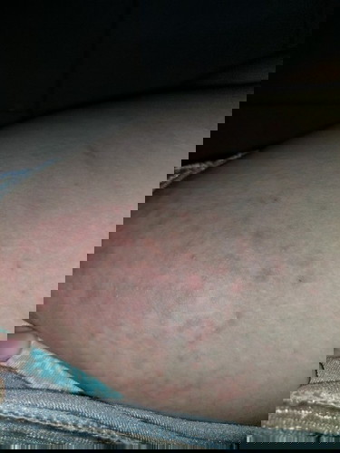 Rashes Normal po ba ito?