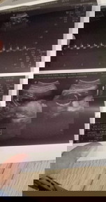 Ultrasound