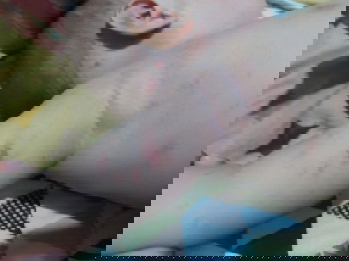 Gatal gatal pada bayi