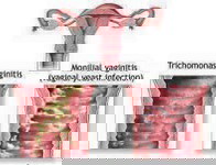 Bagaimana cara menghilangkan keputihan masa pregnant....sbb sekarang byk keputihan yg keluar........