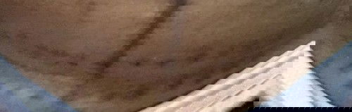 แผลผ่าคลอด 23 วัน ตัดไหมที่อนามัยได้13วัน พึ่งแกะผ้าปิดแผลออก