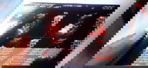 Alhamdulillah Usg waktu umur 16 week😍🤗