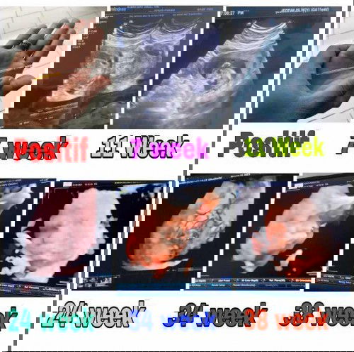 Ini hasil USG ku 🥰