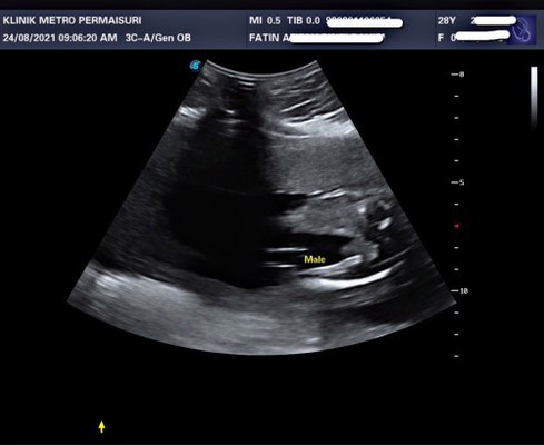 GENDER BABY BOY OR GIRL?