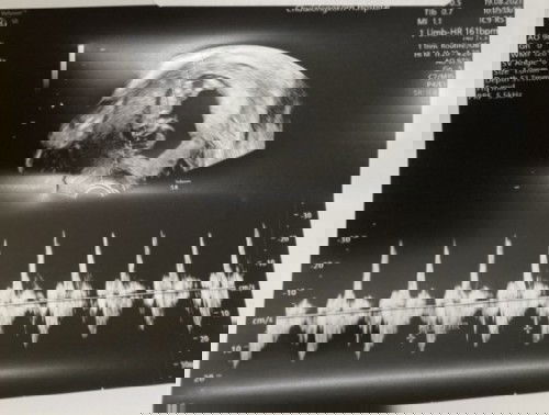 อัพเดทข้อมูลตรวจคัดกรองดาวน์ซินโดรม รพ.จุฬา